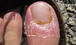 Лікування грибка нігтів
