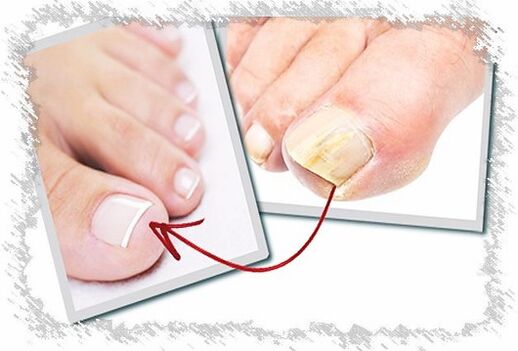 способи лікування грибка на нігтях ніг