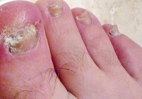 грибок нігтів на ногах
