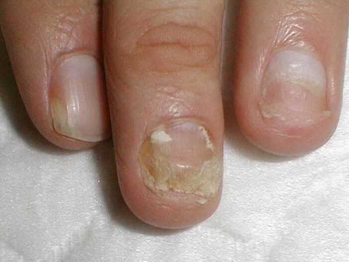 лікування грибка нігтів кандида