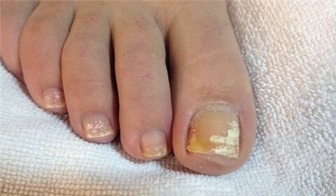 симптоми грибка на нігтях