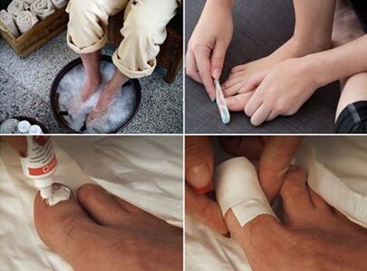 Розпарювання ніг і нанесення на уражені грибком нігті крему з сечовиною
