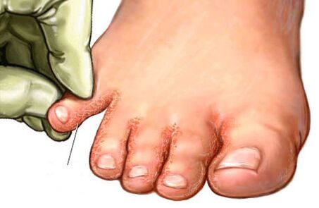 грибок між пальцями ніг