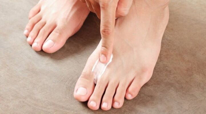 чим і як лікувати грибок між пальцями ніг
