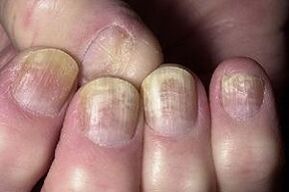 зміна нігтя при грибкових уражень