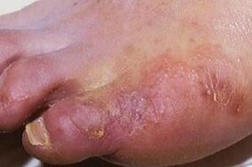 прояви грибкової інфекції на шкірі ніг