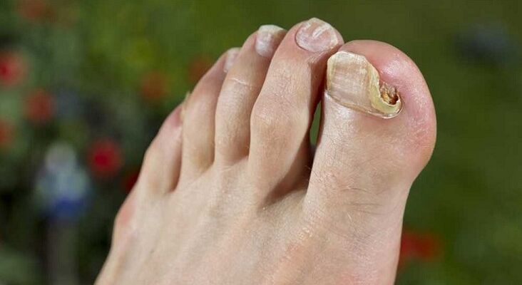 ураження нігтьової пластини при грибку на ногах