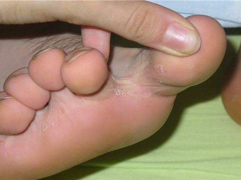 грибок між пальцями ніг фото 1