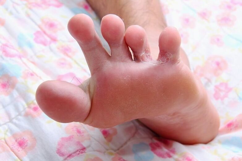 грибок між пальцями ніг фото 2