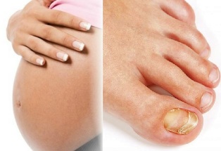грибок на ногах вагітність