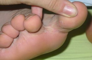 Грибок між пальцями ніг