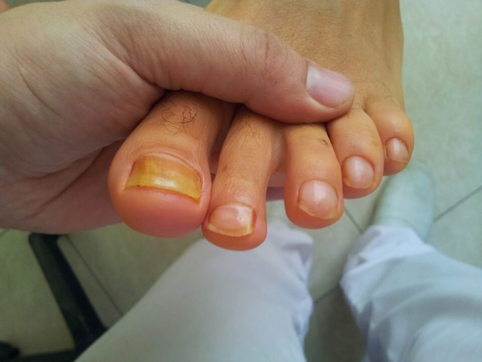 пожовтіння нігтів на ногах при грибку