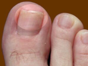Грибок нігтів на нозі - показання до застосування фунгіцидних крапель