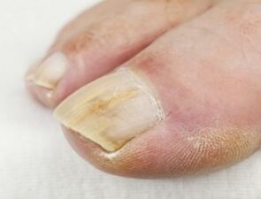 При нагноєнні біля нігтя використовувати протигрибкові краплі не можна