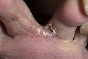грибок шкіри між пальцями ніг