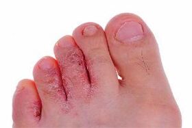 симптоми грибка шкіри на пальцях ніг