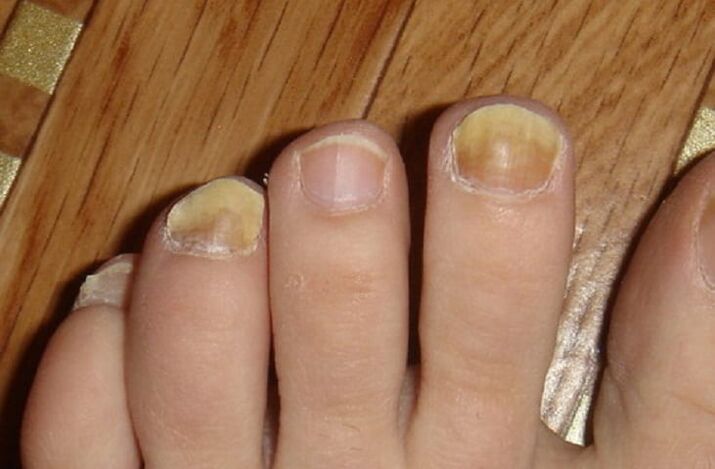 симптоми грибка на нігтях та шкірі ніг