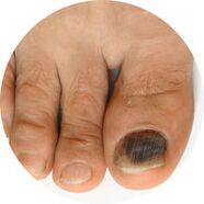 грибок нігтя на нозі як лікувати лаком