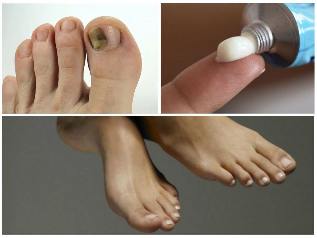 грибок нігтів на ногах лікування