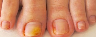 грибок нігтів на ногах симптоми