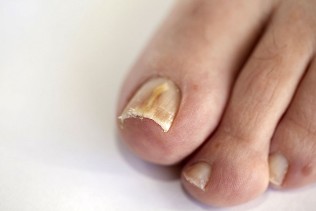 грибок нігтів на ногах