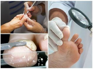 грибок шкіри ніг діагностика