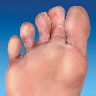 грибок шкіри ніг