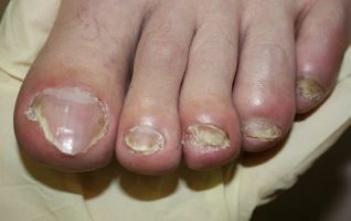 симптоми грибка нігтів