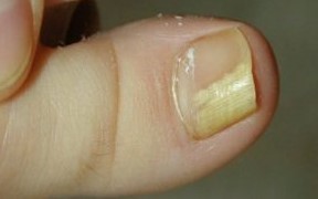 Грибок нігтів